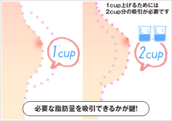 必要な脂肪量を吸引できるかが鍵！