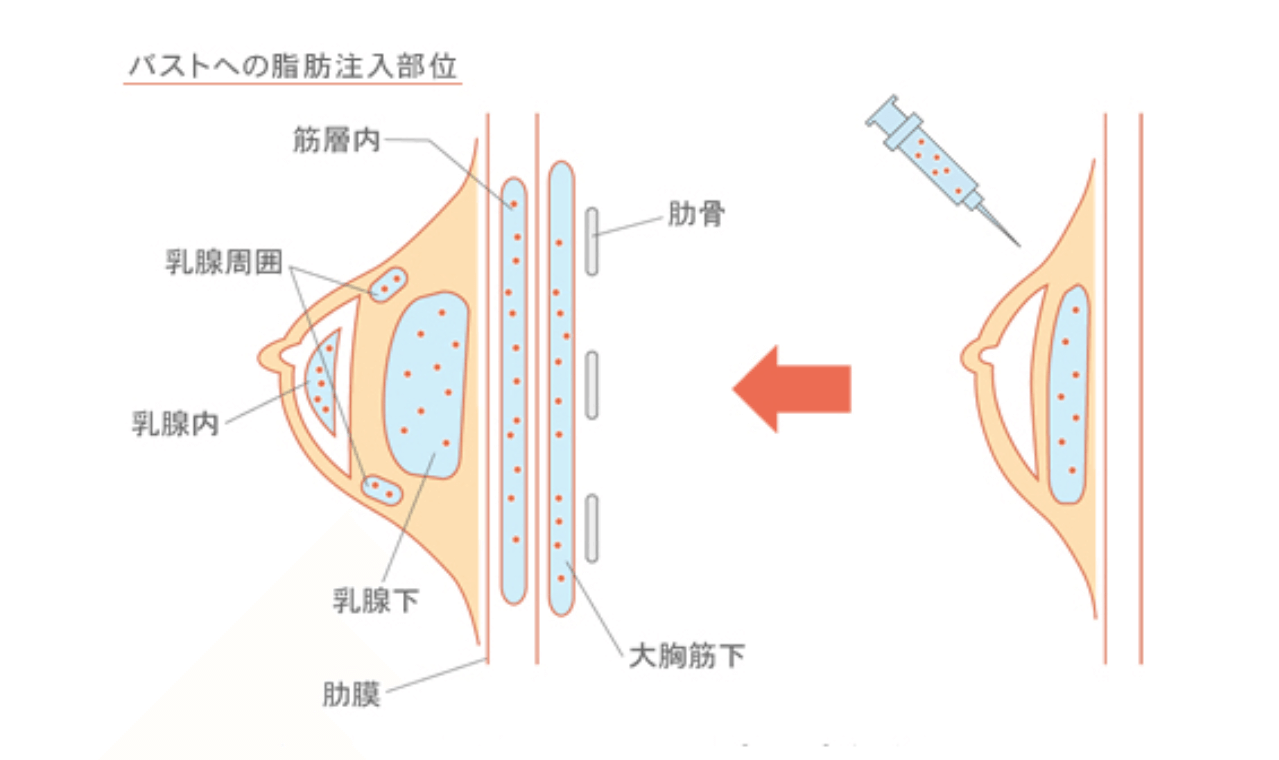 バストへの脂肪注入部位